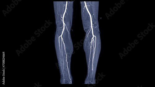 CTA femoral artery run off image of femoral artery for diagnostic Acute or Chronic Peripheral Arterial Disease.