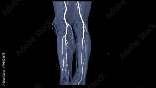 CTA femoral artery run off image of femoral artery for diagnostic Acute or Chronic Peripheral Arterial Disease. photo