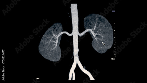 CTA Renal artery 3D is a medical imaging procedure using CT scans to examine the renal arteries It provides detailed images of the blood vessels supplying the kidneys.