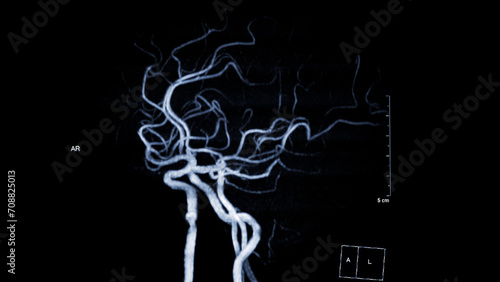 MRA Brain , This imaging technique provides clear visuals of the brain's arterial and venous structures, aiding in the diagnosis of vascular conditions and neurological issues. photo