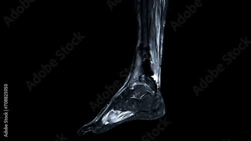 MRI FOOT scan Sagittal view T2 Fat suppression technique for diagnostic tendon injury.