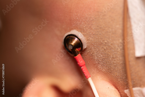 Fotografia EEG electrode attached on patient scalp