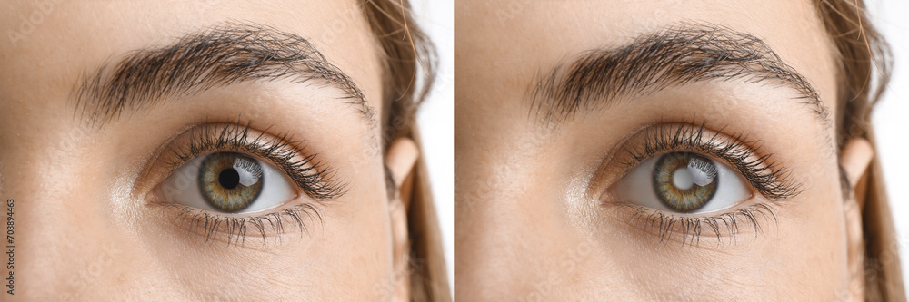 Obraz premium Closeup view of woman before and after glaucoma treatment on white background