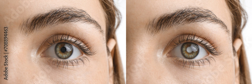 Closeup view of woman before and after glaucoma treatment on white background photo