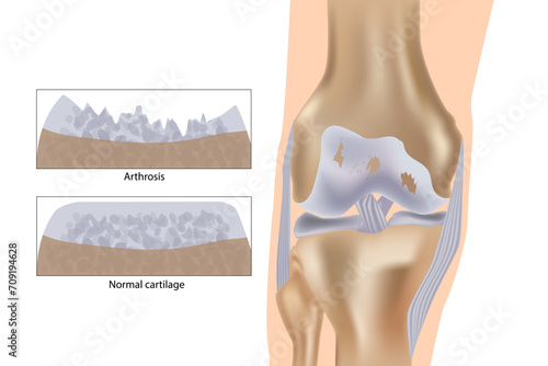 Knee arthrosis. Medical vector illustration with damaged knee structure and healthy knee comparison.