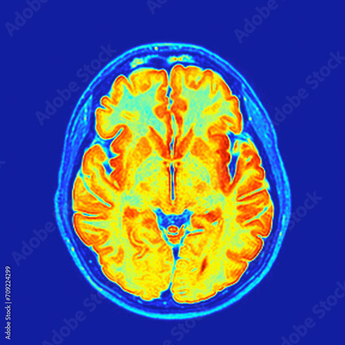 Axial MRI section of a human brain post-processed with colors showing the gray matter, white matter, ventricles and calvaria