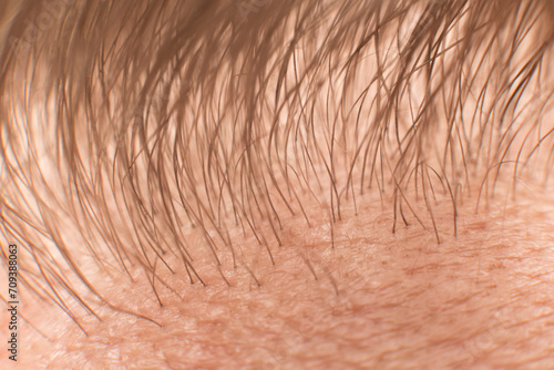 Canvas Print The Hair line on the man forehead - macro close up