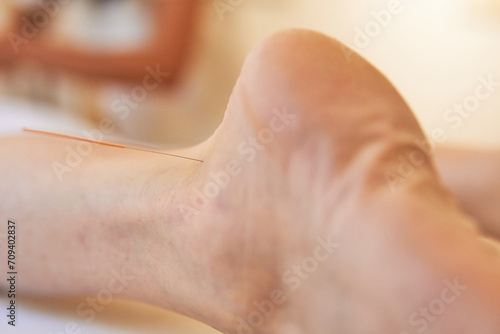 Serene Healing Experience  Acupuncture Therapy on a Females Ankle in a traditional chinese medicine clinic