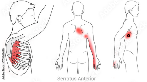 Serratus Anterior: Myofascial trigger points and associated pain locations photo