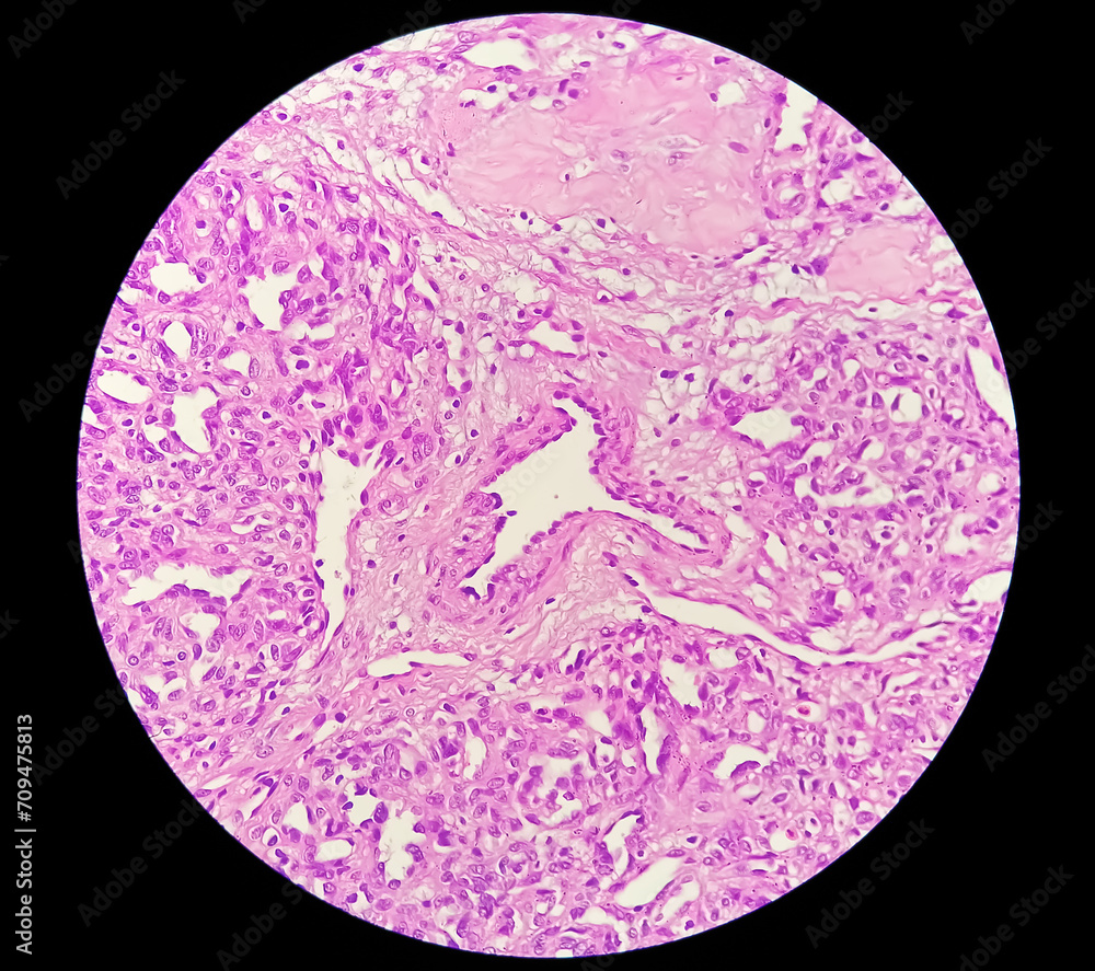 Invasive squamous cell carcinoma of larynx grade 2 Invasive squamous cell carcinoma of larynx grade 2