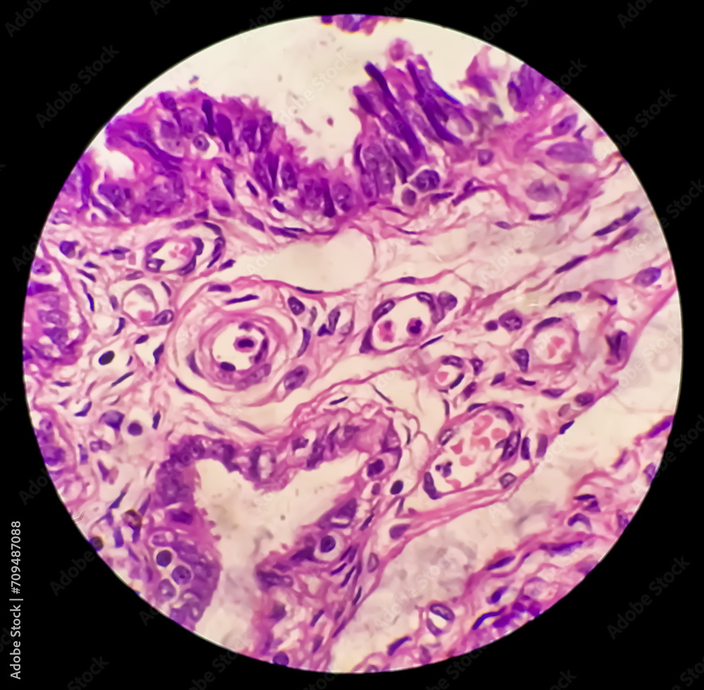 Histopathological photomicrograph of ovarian cyst showing Metastatic ...