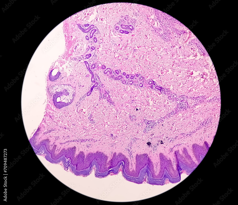 Histological Photomicrograph: Prurigo nodularis (PN) is a chronic disorder of the skin. Histological Photomicrograph: Prurigo nodularis (PN) is a chronic disorder of the skin.