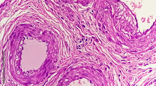 Histopathological photomicrograph of ovarian cyst showing Metastatic cystic teratoma. photo