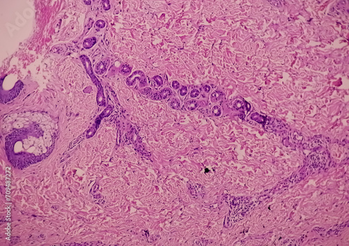 Fotografi Histological Photomicrograph: Prurigo nodularis (PN) is a chronic disorder of the skin