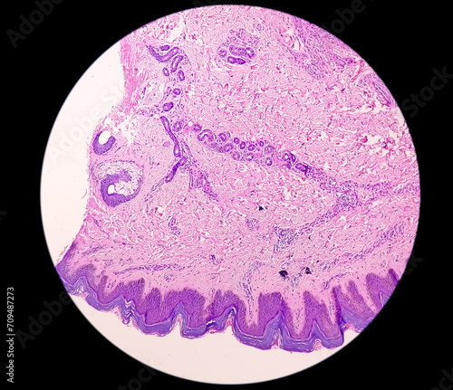 Histological Photomicrograph: Prurigo nodularis (PN) is a chronic disorder of the skin.  photo