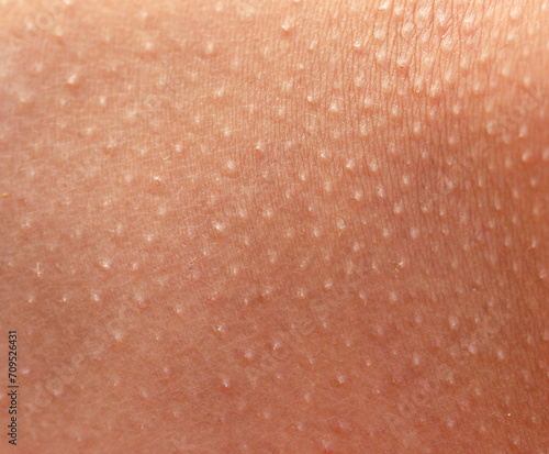 cold rash on the skin as a background. photo