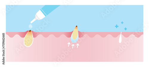 Direction for use blackhead treatment gel vector illustration on sky blue background. Cross section of use acne cream, reduce clogged pore, non inflammatory acne and tighten pore. 