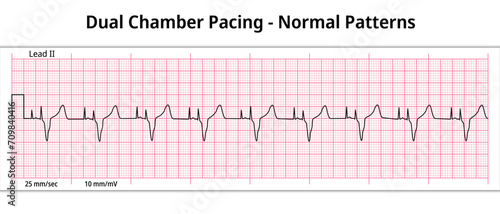 ECG Dual Chamber Pacemaker Rhythm - Normal Pattern - 8 Second ECG Paper - Electrocardiography Vector Medical Illustration