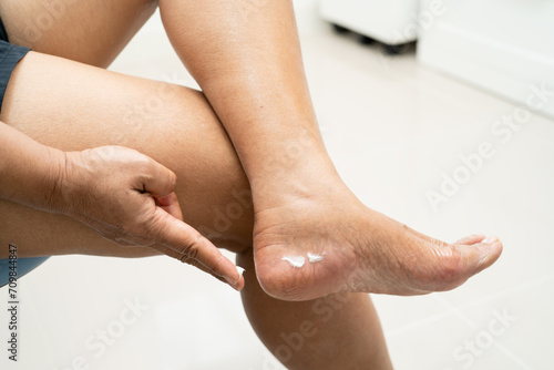 Asian woman care feet with cracked and dry heel skin cream at home. photo