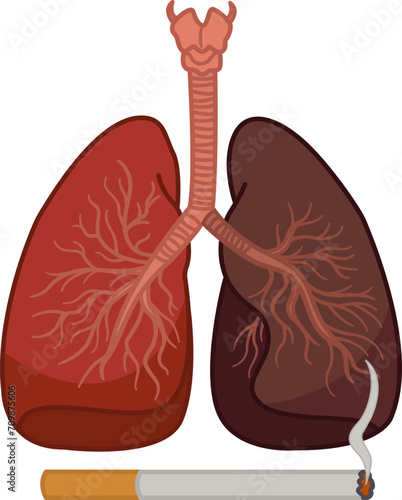 Healthy Lung and Smoker's Lung. The danger of smoking on the human respiratory system. Lungs cancer. Vector Illustration of Human Internal Organs