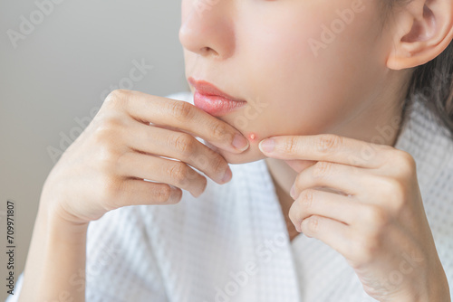 Expression worry asian young woman hand touching pustule around the chin and mouth, allergic when wear mask, makeup, show squeezing pimple spot from face. Beauty care, skin problem by acne treatment.