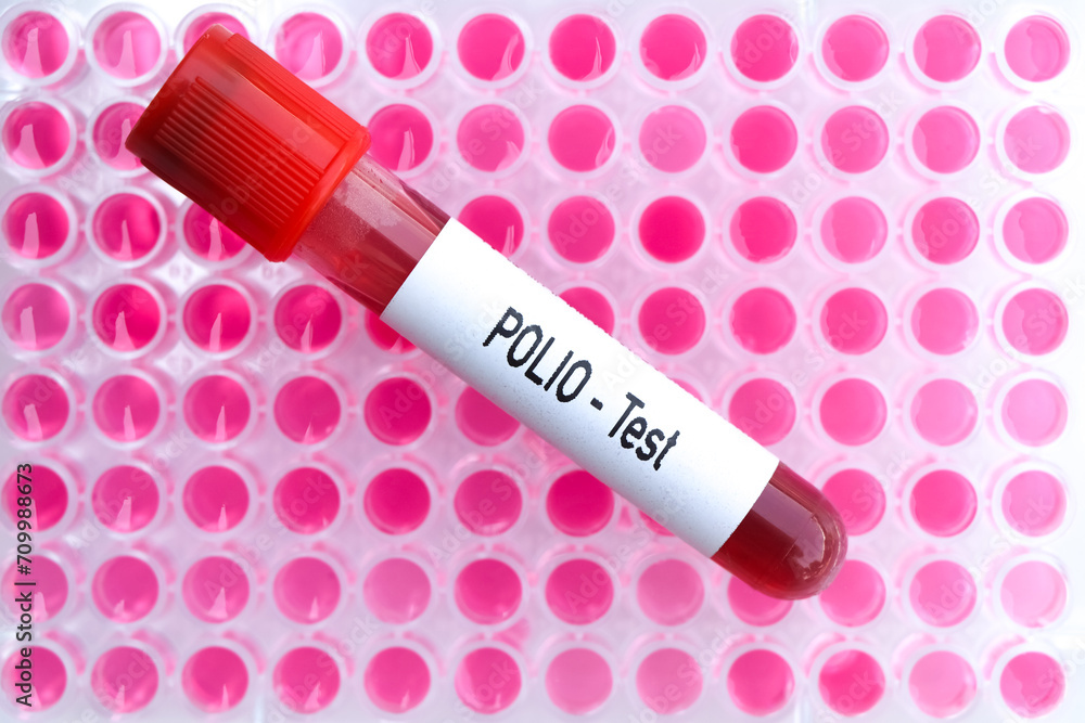 POLIO test to look for abnormalities from blood POLIO test to look for abnormalities from blood