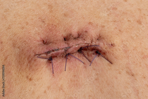 Принти на полотні Dissolvable stitches applied following lipoma removal surgery, highly detailed s