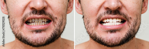 Man s teeth before and after whitening and alignment  braces . Oral care