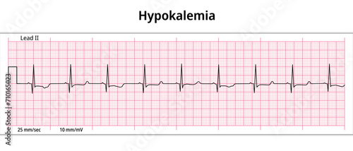 ECG Hypokalemia - Hypokalaemia - 8 Second ECG Paper - Electrocardiogram Vector Medical Illustration