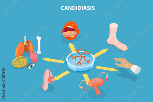 3D Isometric Flat Vector Illustration of Candidiasis, Medical Infographics