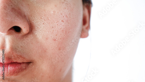 Asian face, Macro skin with enlarged pores. Allergic reaction, peeling, care for problem skin.