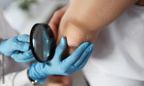 Dermatologist examines patient's hand through magnifying glass. Skin rashes and irritation concept photo