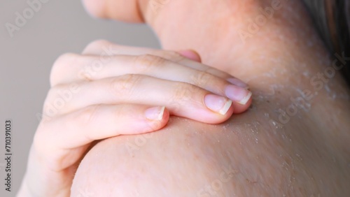 Fotografie Peeling skin on shoulder due to dehydration close-up rear view effect of dehydra