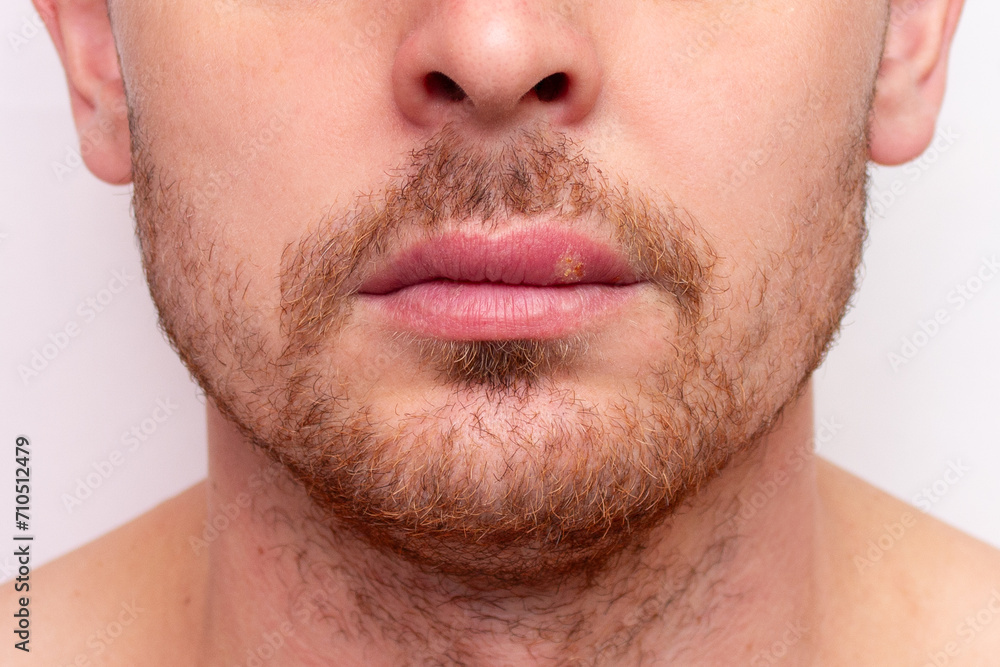 Close-up portrait of a Caucasian man with herpes on his lips. Manifestation of a viral infection in the form of vesicular ulcers. Decreased immunity or cold. Beauty and dermatology concept Close-up portrait of a Caucasian man with herpes on his lips. Manifestation of a viral infection in the form of vesicular ulcers. Decreased immunity or cold. Beauty and dermatology concept