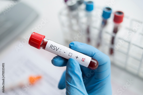 Positive laboratory blood test for the RSV virus. photo