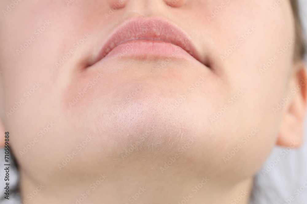 Closeup view of woman with dry skin Closeup view of woman with dry skin