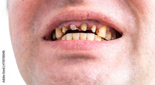 Periodontal disease, loose teeth in toothless man mouth, close up. Dental problems and orthodontic treatment for patient. photo