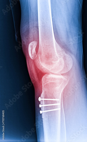 X-ray Knee Joint Fracture proximal tibia and Post fix fracture proximal tibia with plate and screws, highlighted in red photo