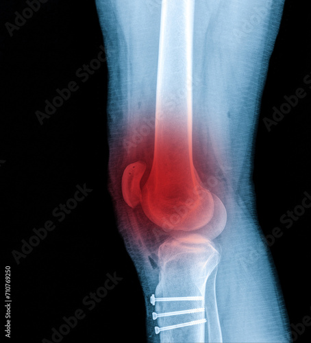 X-ray Knee Joint Fracture proximal tibia and Post fix fracture proximal tibia with plate and screws, highlighted in red photo