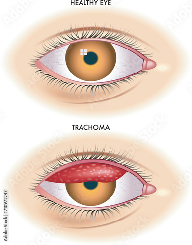 Medical illustration shows the comparison between a normal eye and one affected by trachoma an infectious disease caused by bacterium Chlamydia  trachomatis.