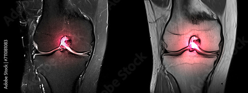 Magnetic resonance imaging or MRI of knee.Closed injury of the knee joint, with manifestations of arthrosis.Knee pain in sport injury.Orthopedic surgeon plan cruciate ligament reconstruction surgery. photo