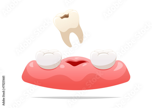 Cavities are removed from the gums. Dental health concept. Vector illustration.