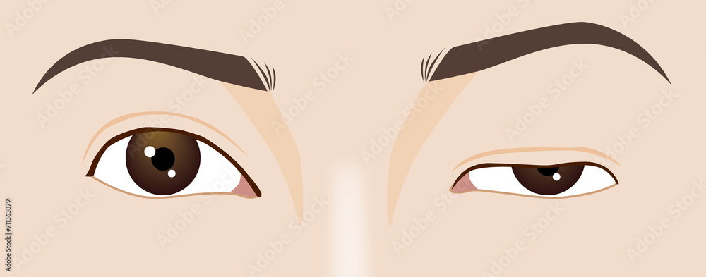 Droopy eyelid ptosis, blepharoplasty symptom, myasthenia gravis, illustration - obrazy, fototapety, plakaty 