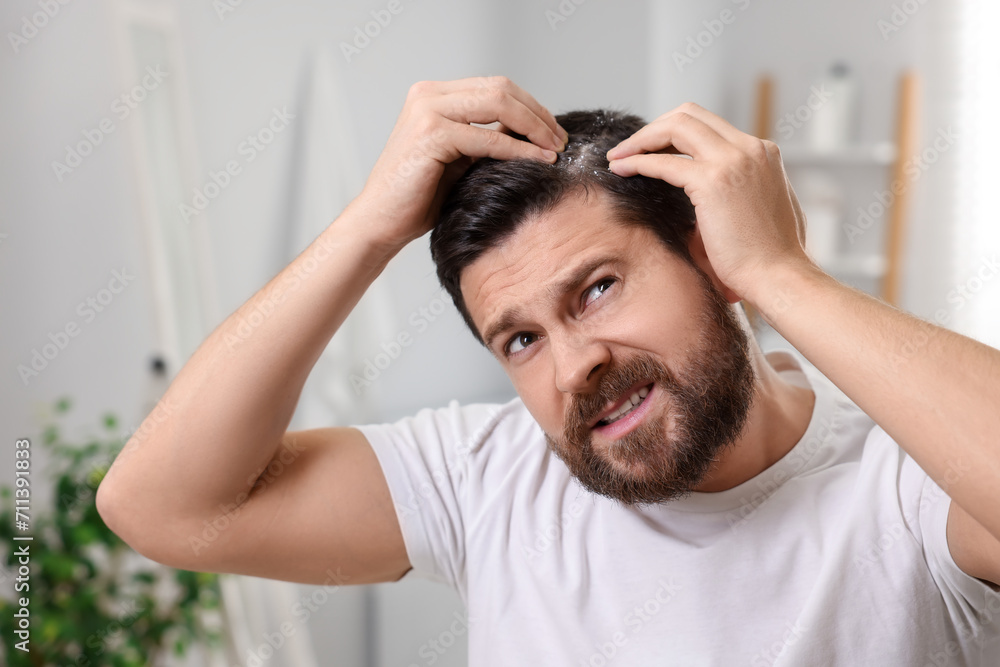 Emotional man with dandruff in his dark hair at home Emotional man with dandruff in his dark hair at home