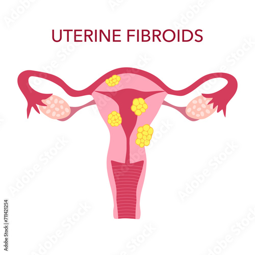 Uterine fibroids disease in flat design vector illustration.