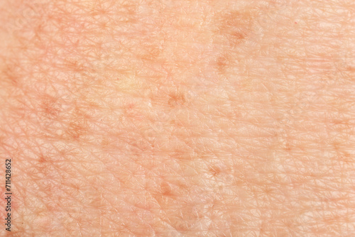 Texture of skin with pigmentation as background, macro view photo