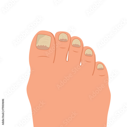 Swollen toe, onychocryptosis. Foot with nail disease or infection. Foot with onychomycosis or nail fungus. Healthcare and medicine. Vector