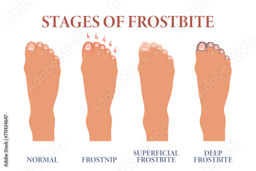 Photos Frozen toes