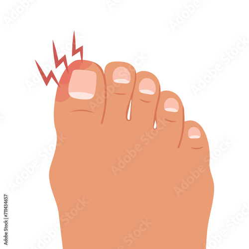 Swollen toe, onychocryptosis. Foot with nail disease or infection. Foot with onychomycosis or nail fungus. Healthcare and medicine. Vector