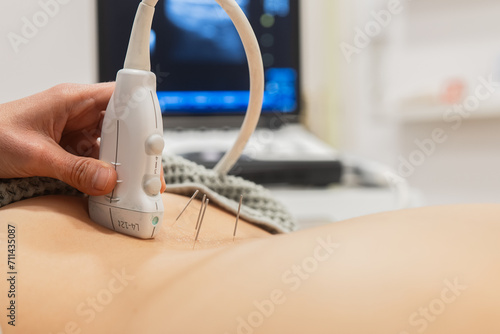 Ultrasound therapy alongside acupuncture for pain relief photo